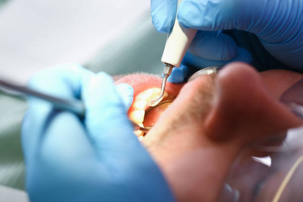 Best Emergency Treatment for Dental Infections or Abscesses in Blackfoot, ID